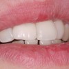 Protetyka - Wystająca z łuku jedynka. Pacjent chciał poprawić swój uśmiech bez konieczności długotrwałego noszenia aparatu ortodontycznego