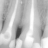 Leczenie kanałowe - Nawet zęby z dużymi zmianami zapalnymi można z powodzeniem leczyć.