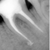 Leczenie kanałowe - Ząb trzonowy dolny wymagający usunięcia wkładu i leczenia kanałowego.